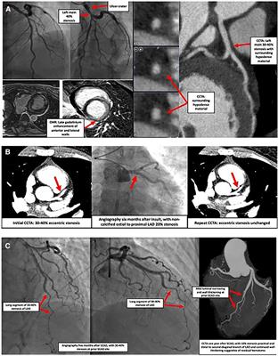 Spontaneous coronary artery dissection: a focus on post-dissection care for the vascular medicine clinician